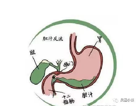 胆汁反流性胃炎症状