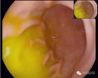 胆汁反流胃镜图片图片