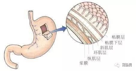 大夫，我的胃“烂了“，还能活多久？——糜烂性胃炎