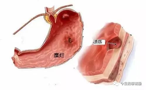 糜烂性胃炎吃什么药能好点？饮食方面要注意些什么？