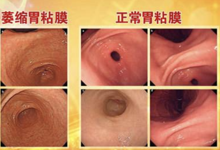 萎缩性胃炎的一些小秘密