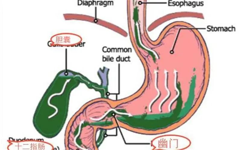 胆汁反流性胃炎是怎么造成的，反流多久会发生癌变？