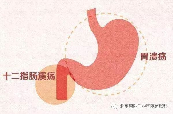胃疼小心十二指肠溃疡，与胃溃疡有何区别？