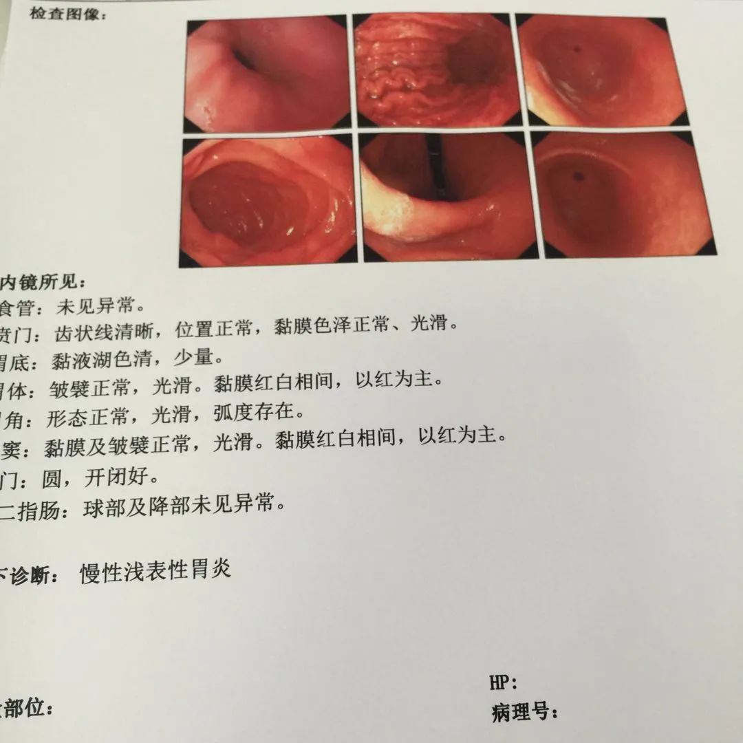 浅表性胃炎是怎么造成的？
