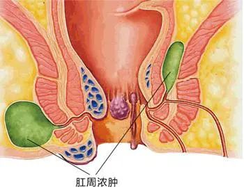 肛门疼痛原因多， 看看你是哪一种