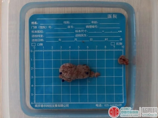 医生手记：过了四十岁一定要做次肠镜检查，关键时刻能救命！