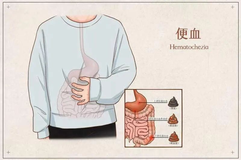 大便带血需要做哪些检查？