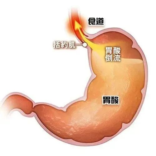 胃食管反流饮食须注意什么？饮食谨记“3忌3戒”！