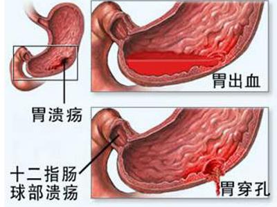 糜烂性胃炎和十二指肠溃疡好治吗？