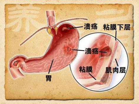 经常恶心、胃痛要警惕十二指肠溃疡？盘点十二指肠溃疡的7大症状，早发现早治疗！