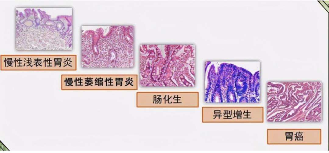 浅表性胃炎伴糜烂会癌变吗？浅表性胃炎伴胆汁反流的原因是什么？