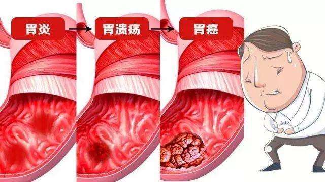 哪些疾病容易与急性胃炎相混淆