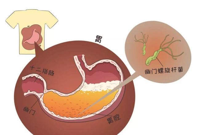 治疗委缩性胃炎最好的方法是什么？幽门螺旋杆菌阳性症状是什么？