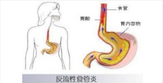 食管狭窄症状是什么？食管糜烂一年后癌变吗？