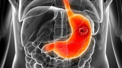 胃炎吃什么药：急性糜烂性胃炎的治疗