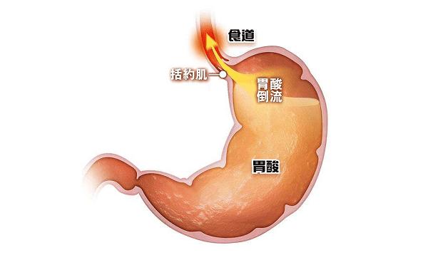 胃食管反流病是怎么引的？治疗护理4步走，帮你解决胃食管反流病！