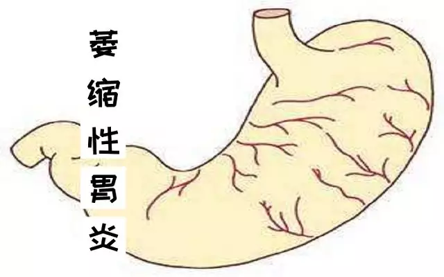 萎缩性胃炎会癌变？别慌，这3种治疗方法可慢慢恢复！