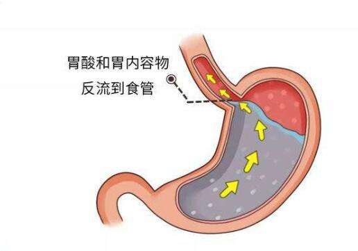 总是想反酸水，胃里感觉很灼热，小心是得了反流性食管炎