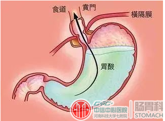 胃食管反流与反流性食管炎的区别