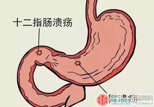 胃溃疡和十二指肠溃疡，两者的区别，你看懂了吗？