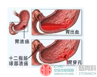 胃溃疡真的是由“饮食不规律”引起的吗？