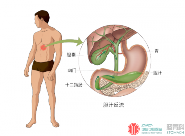 胆汁“造反”，胃遭殃——警惕胆汁反流性胃炎