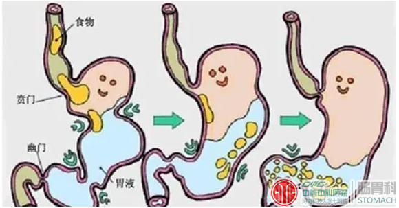 反流性胃炎，可能是最痛不欲生的胃病，这三招教你如何根治