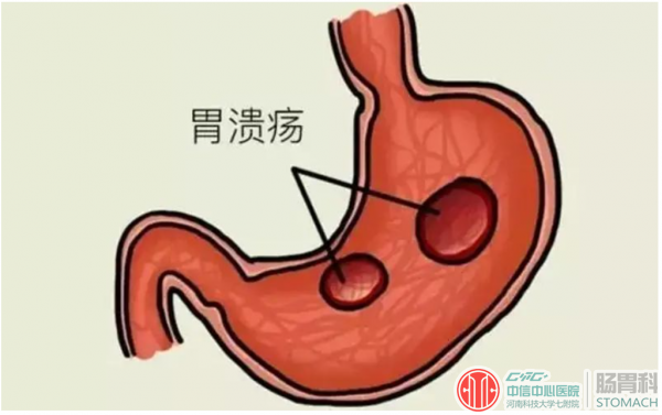 胃溃疡是怎么形成的？主要是这3个不良因素导致