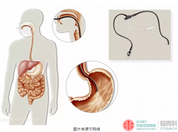 一次胃镜检查时间需要多久？胃镜会带来不适吗？