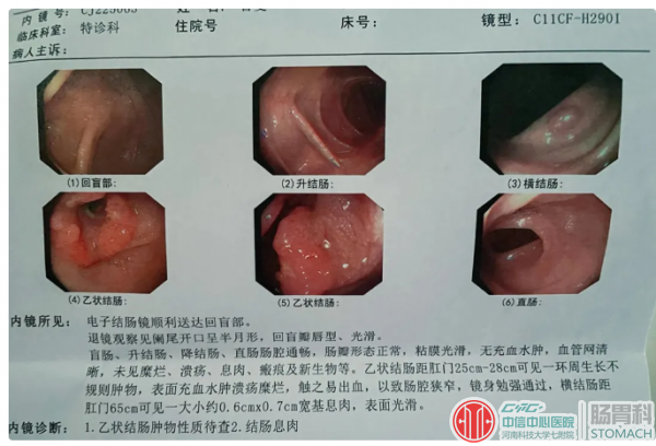 患者自述：女，37岁，2个女儿，结婚10周年纪念日，查出肠癌