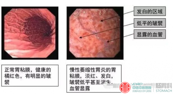 常说的萎缩性胃炎伴糜烂是咋回事？